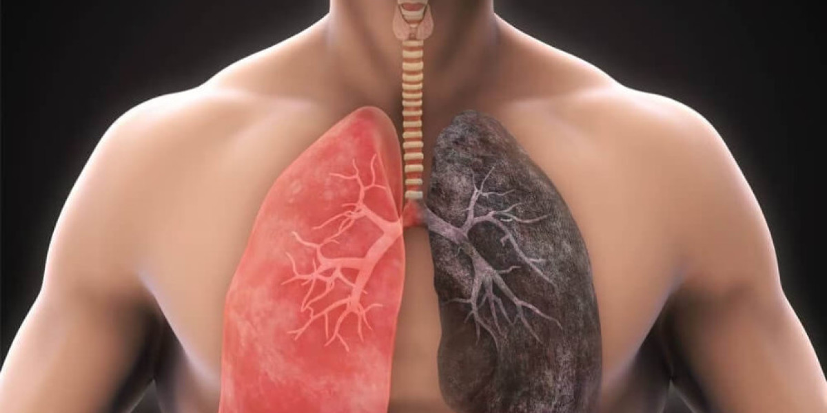 Global Idiopathic Pulmonary Fibrosis Treatment Market: Trends, Growth, & Future Outlook | 2024 - 2032