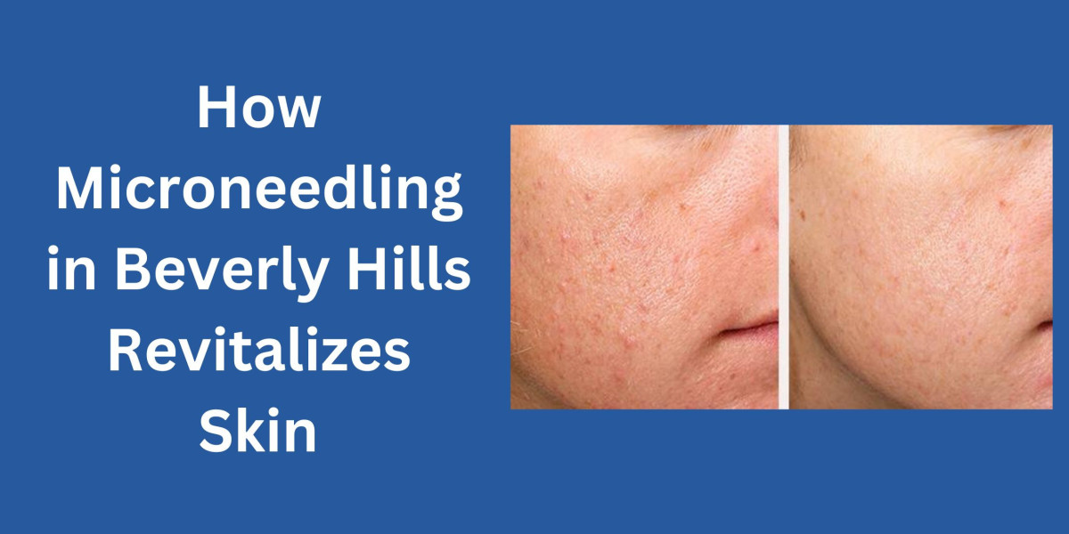 How Microneedling in Beverly Hills Revitalizes Skin