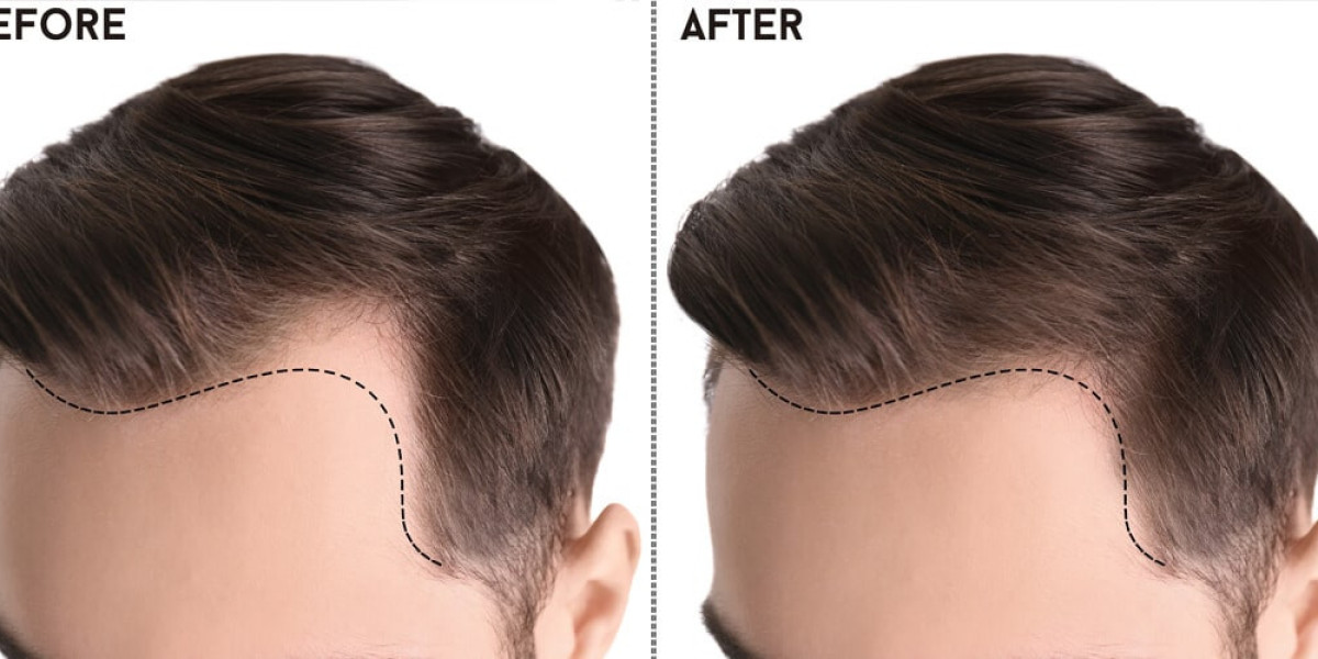 Hair Transplant in Islambad: Everything You Need to Know