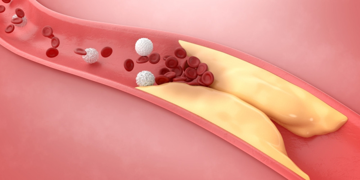 Atherosclerosis vs. Arteriosclerosis: Causes, Symptoms, and Treatment