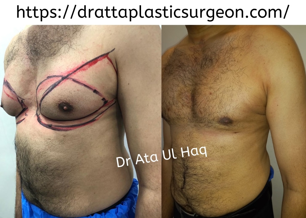 Gynecomastia Surgery In Lahore - Dr. Ata Best Plastic Surgeon