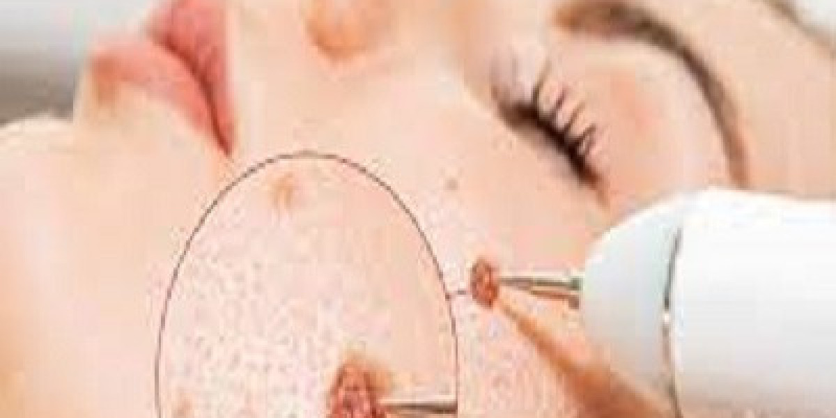 Wart Removal Treatment: A Complete Guide