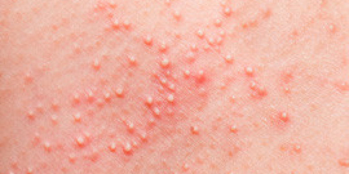 What Are the Best Home Remedies for Skin Rashes?